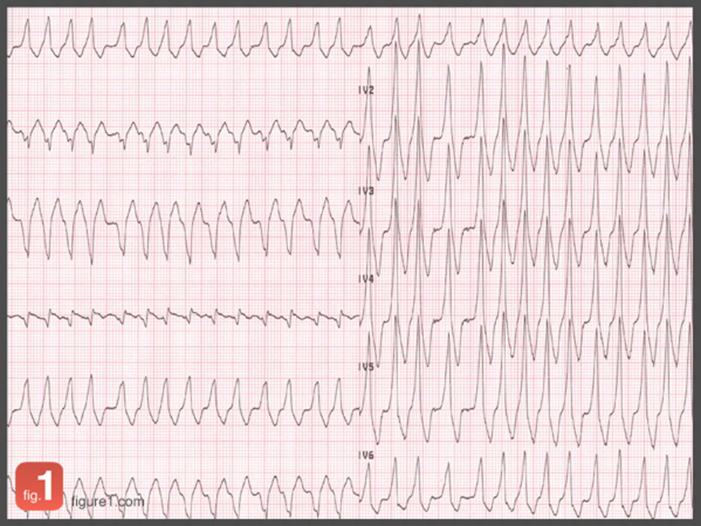 Heart Failure Rythm Heart failure ‘most common’ complication of atrial fibrillation ...